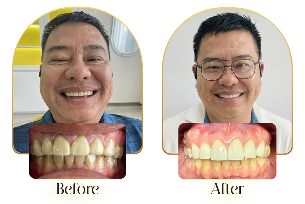 Khi tới khám tại Kha Dental Nha Trang, chú thấy cơ sở vật chất ở đây rất là hiện đại, sạch sẽ, tiện nghi, tạo cảm giác ấm cúng như ở nhà. Các cô điều dưỡng nha khoa rất gần gũi và chăm sóc chú nhiệt tình lắm. Đặc biệt, Bác sĩ Ngọc Kha-giọng nói nhẹ nhàng, tự tin, thao tác điều trị dứt khoát, cắm implant và làm răng sứ cho chú không có đau một chút nào cả, chú ngủ quên lúc nào không hay! Sau khi được bác sĩ Kha làm thẩm mỹ nụ cười, chú cảm thấy bản thân tự tin hơn rất nhiều khi cười, thoải mái đi họp lớp với bạn bè nhân dịp về lại quê hương!Chú Huỳnh Viết Bảo Duy - Việt kiều Mỹ50 tuổi Dịch vụ răng sứ thẫm mỹ Lava