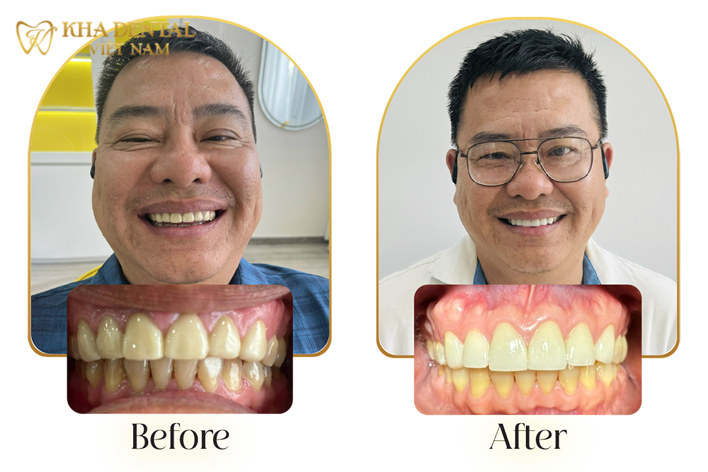 Khi tới khám tại Kha Dental Nha Trang, chú thấy cơ sở vật chất ở đây rất là hiện đại, sạch sẽ ,tiện nghi ,tạo cảm giác ấm cúng như ở nhà. Các cô điều dưỡng nha khoa rất gần gũi và chăm sóc chú nhiệt tình lắm. Đặc biệt , Bác sĩ Ngọc Kha-giọng nói nhẹ nhàng , tự tin, thao tác điều trị dứt khoát, cắm implant và làm răng sứ cho chú không có đau một chút nào cả, chú ngủ quên lúc nào không hay! Sau khi được bác sĩ Kha làm thẩm mỹ nụ cười , chú cảm thấy bản thân tự tin hơn rất nhiều khi cười, thoải mái đi họp lớp với bạn bè nhân dịp về lại quê hương!
Chú Huỳnh Viết Bảo Duy - Việt kiều Mỹ50 tuổi Dịch vụ răng sứ thẫm mỹ Lava