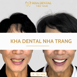 Bước vào hành trình niềng răng, tự tin mùa tựu trường sắp tới