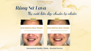 Phục Hình 2 Trụ Implant Kuwontech Hàn Quốc + Cầu Răng Sứ Zirconia – Khách Hàng Anatasia (37 tuổi – Đến Từ Nga)