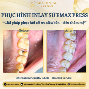 Ưu đãi vàng mừng lễ 2/9 cho niềng răng và phục hình sứ