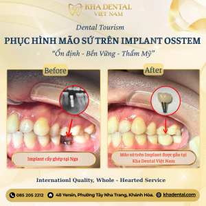 Ưu đãi vàng mừng lễ 2/9 cho niềng răng và phục hình sứ