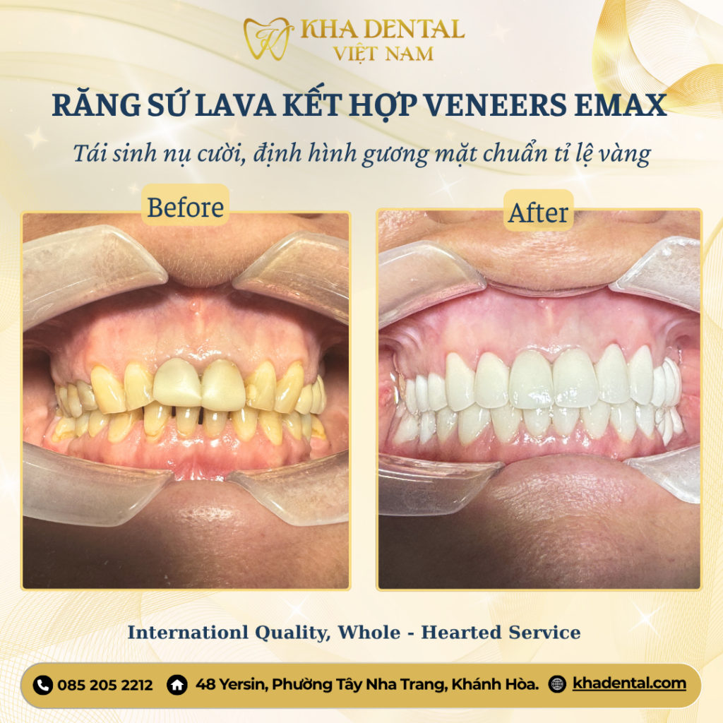 Trẻ hóa khuôn mặt bằng phục hồi toàn miệng