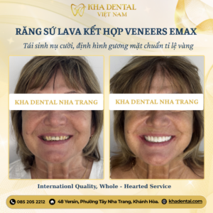 Răng Sứ Thẩm Mỹ DDBIO | Kha Dental Nha Trang – Tự Tin Tỏa Sáng