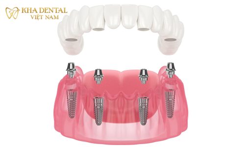 cay-ghep-implant-toan-ham-2000×1200 cay-ghep-implant-toan-ham-2000x1200