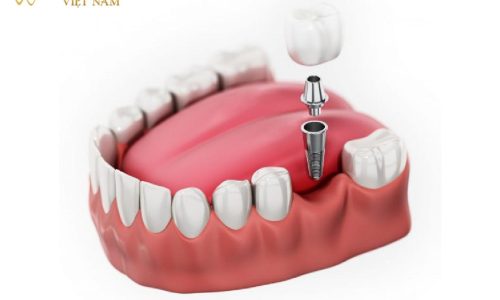 trong răng 1 răng edit-01 trong răng 1 răng edit-01